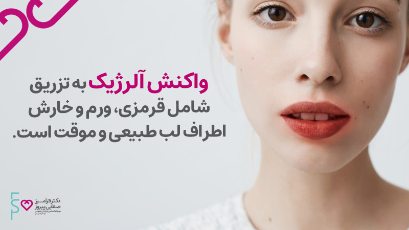 مراقبت بعد از تزریق ژل لب | قیمت ژل لب ژوویدرم